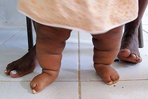 1306 dia da crianca e prevencao da obesidade cpf