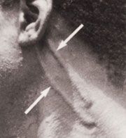 mancha hanseniase neural