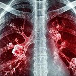 Tosse que não passa pode ser tuberculose? Saiba quando se preocupar